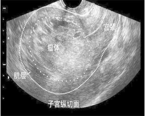妊娠糖尿病血糖标准