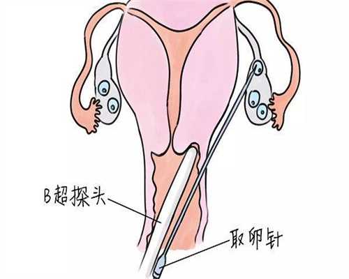 如何诊断检查子宫内膜炎