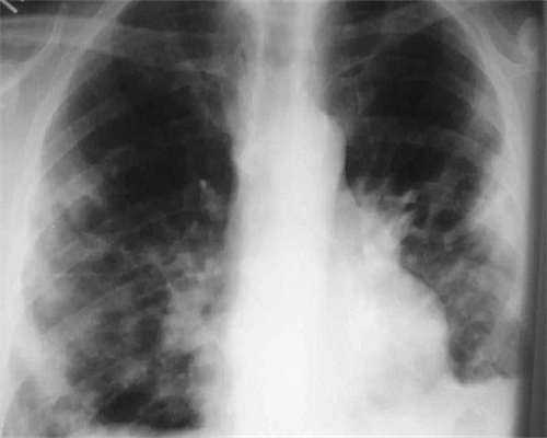 子宫内膜薄跟痛经有关吗-卵泡不长吃什么药